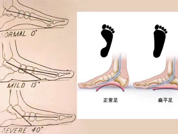 扁平足最新研究及治疗进展概览